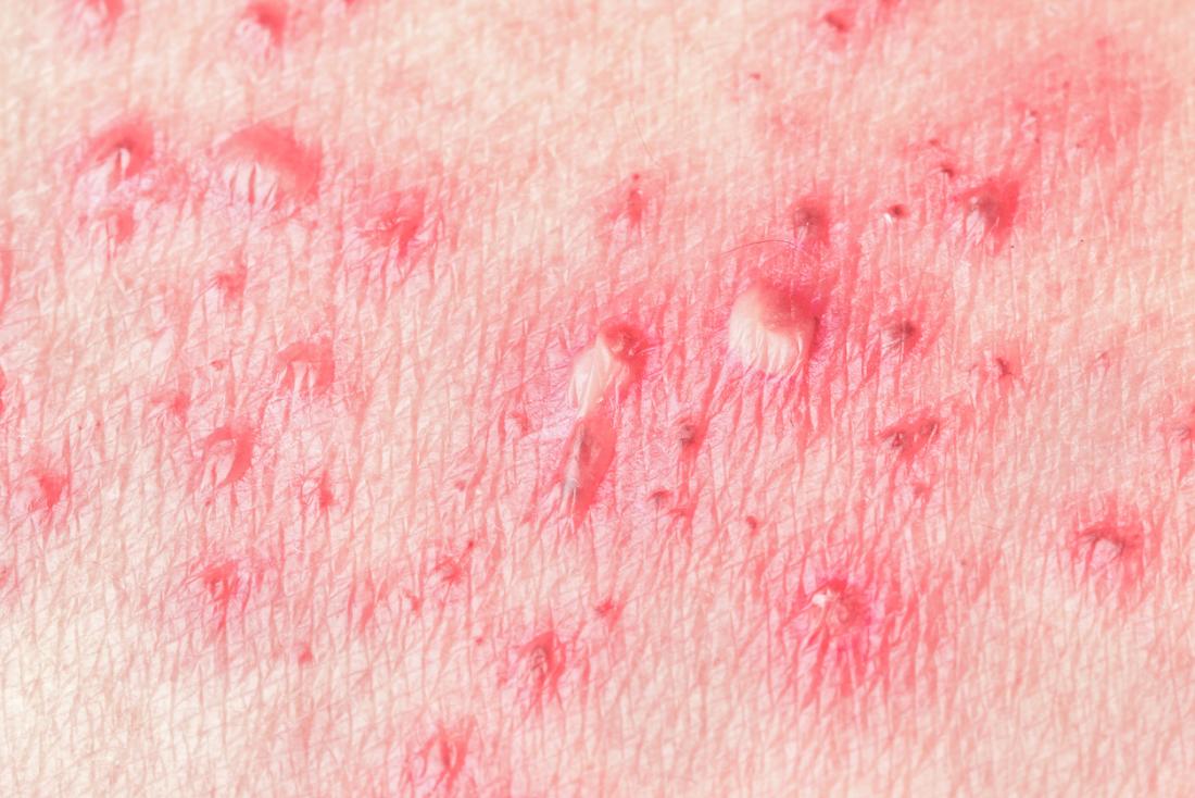 varicella, foto hd, herpes zoster