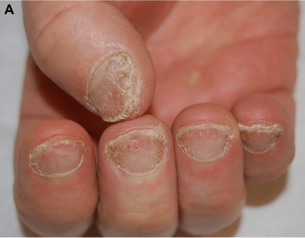 psoriasi delle unghie