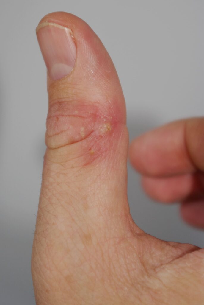 Dermatite Atopica dito